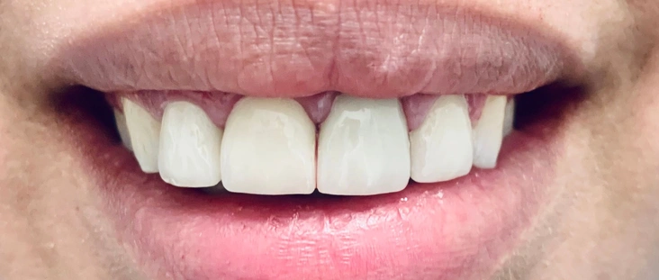 After - Smile transformation case 3