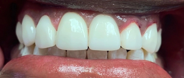 After - Smile transformation case 5