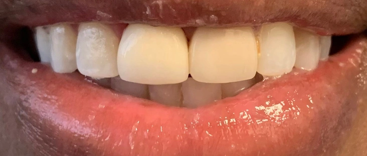 After - Smile transformation case 8