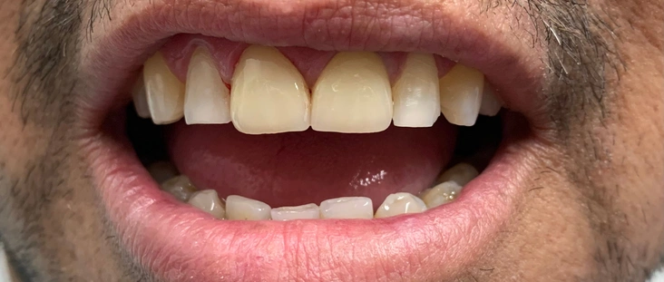 After - Smile transformation case 9