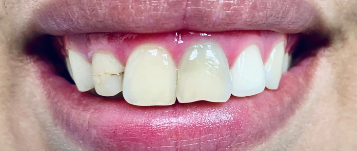 Before - Smile transformation case 3