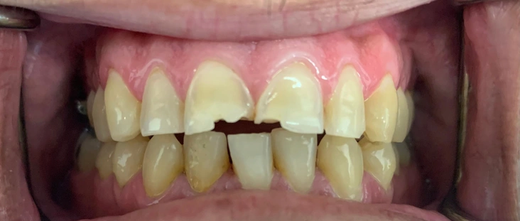 Before - Smile transformation case 9