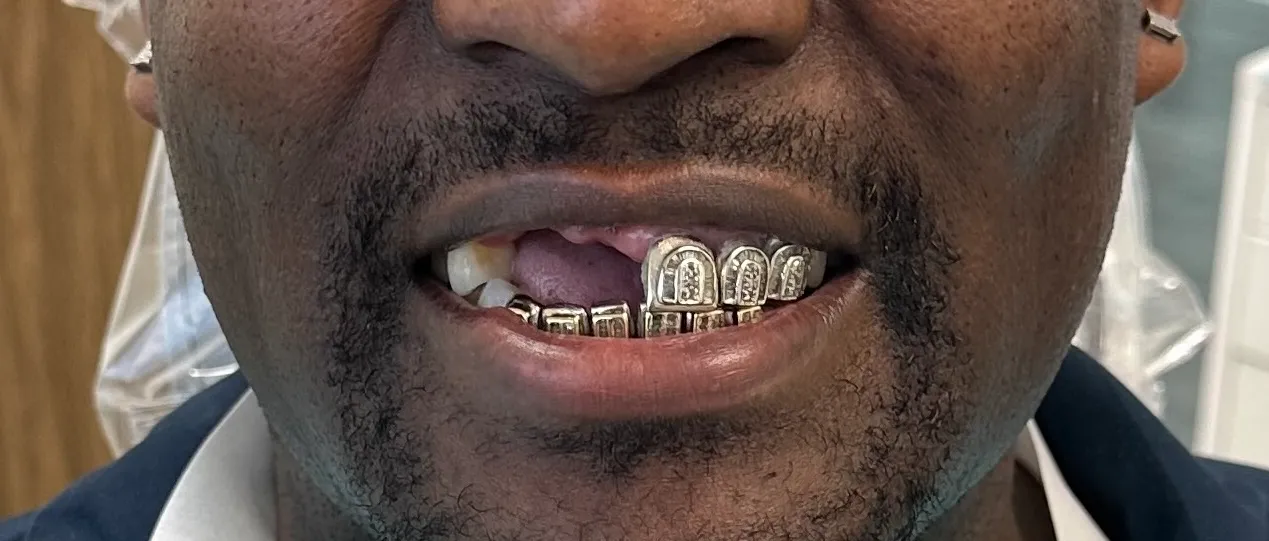 Before - Smile transformation case 2